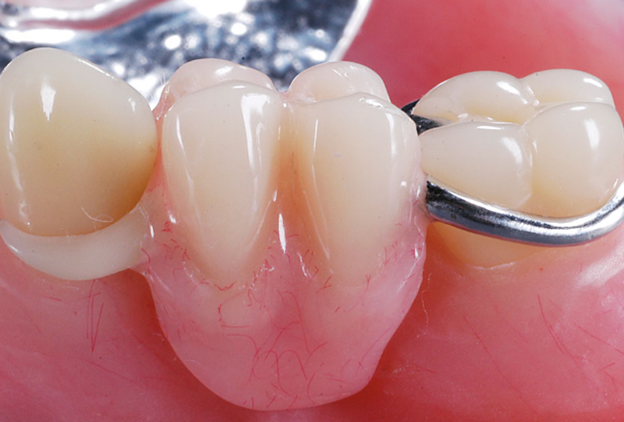 Доступные зубные протезы